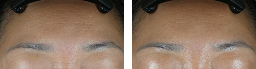 Resultados do tratamento na face